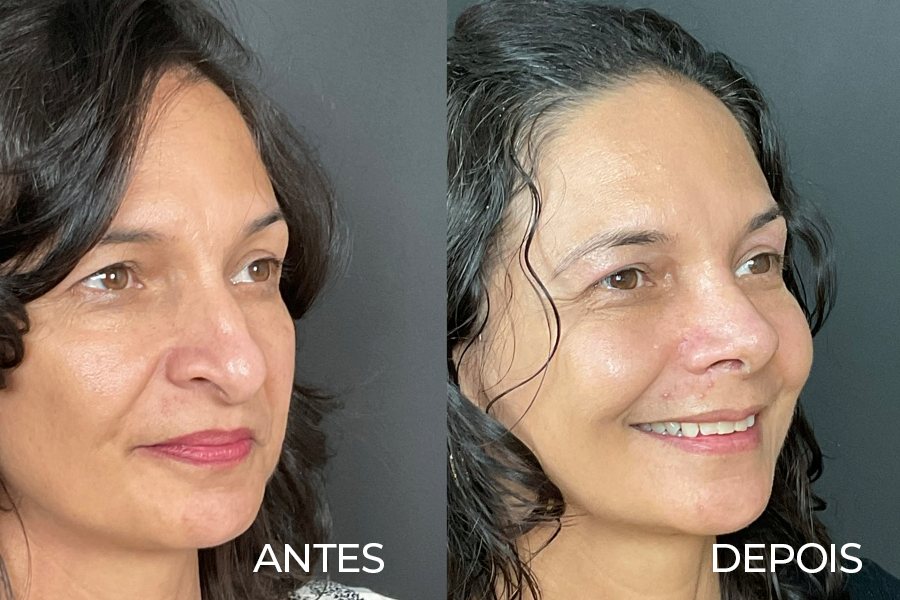 Resultado de rinoplastia 1 – antes e depois