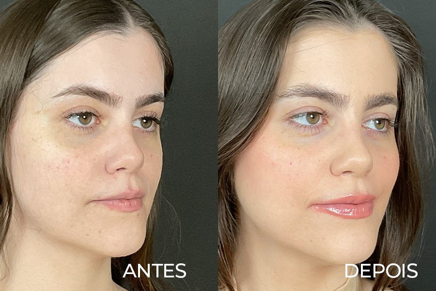 Resultado de rinoplastia 2 – antes e depois